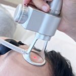Professional CO2 Laser resurfacing procedure for skin rejuvenation