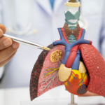 Pneumonia Treatment Market