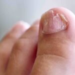 Specialist for Ingrown Toenail in Singapore