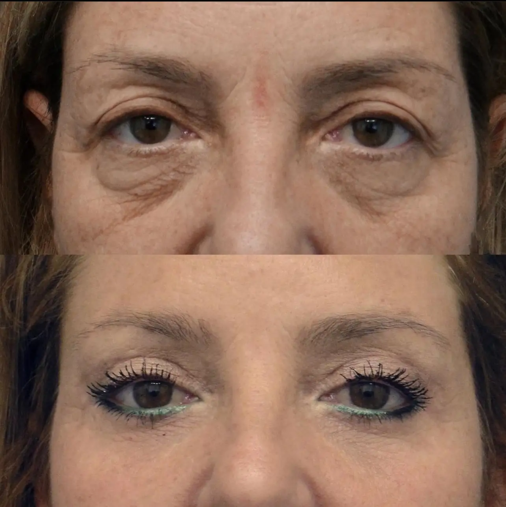 Eye Bag Removal in Dubai