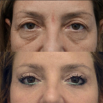 Eye Bag Removal in Dubai