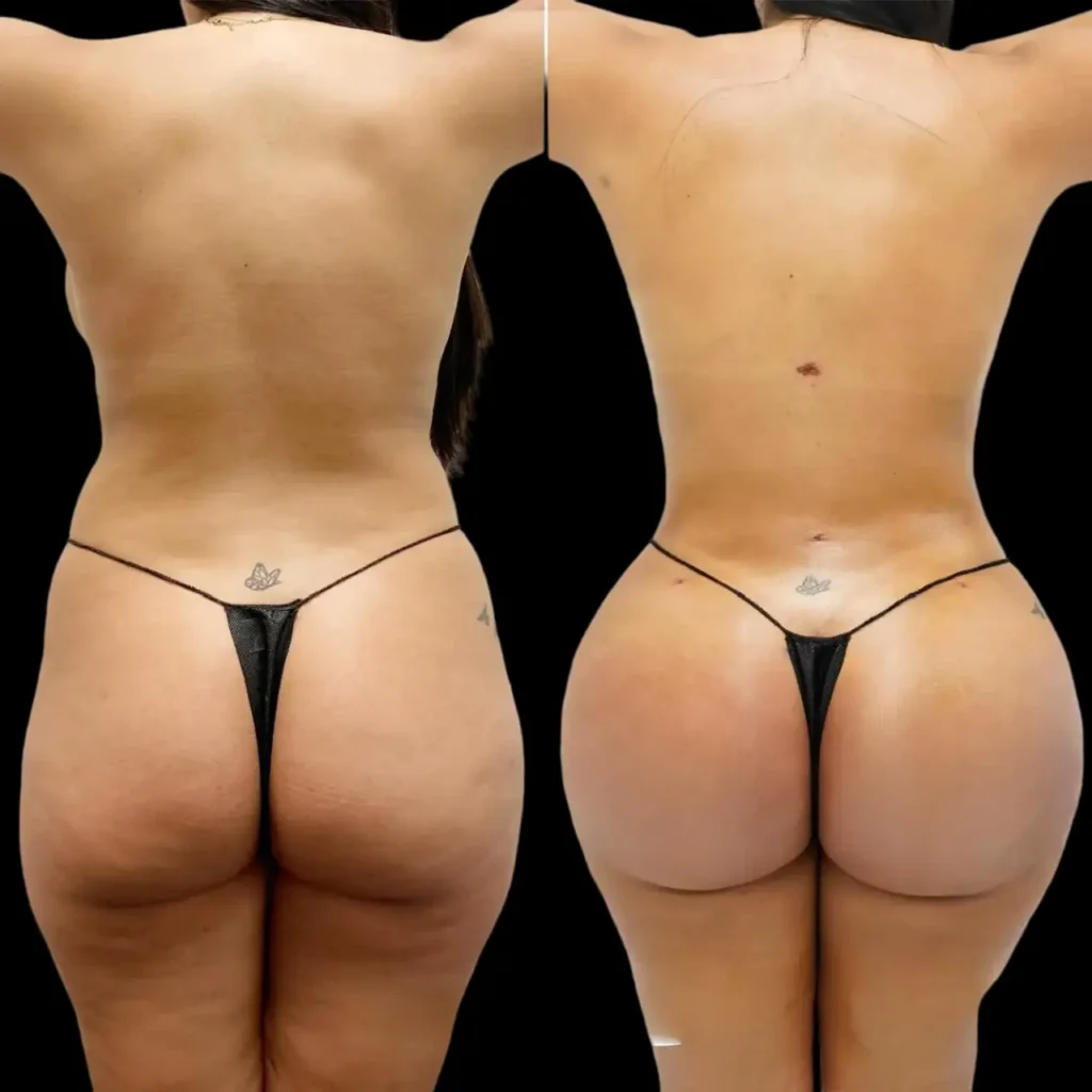 Butt Fat Transfer in Dubai 
