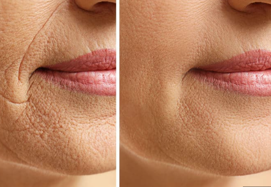 filler for smoker lines before and after