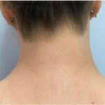 underarm laser hair removal