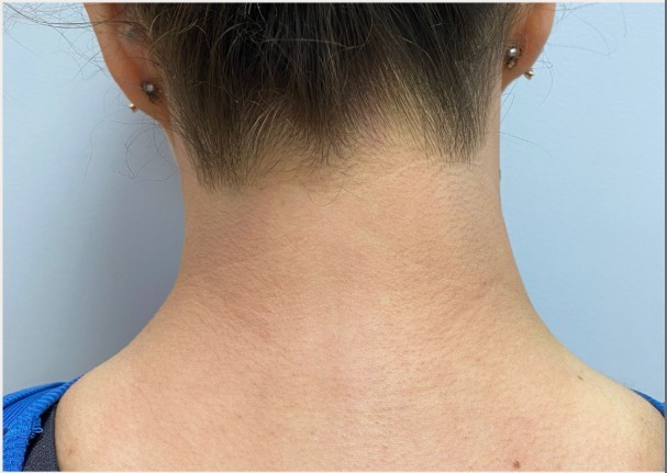 underarm laser hair removal