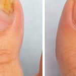 nail fungus treatment in Singapore - fungus nail specialist
