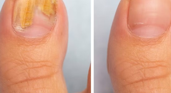 nail fungus treatment in Singapore - fungus nail specialist