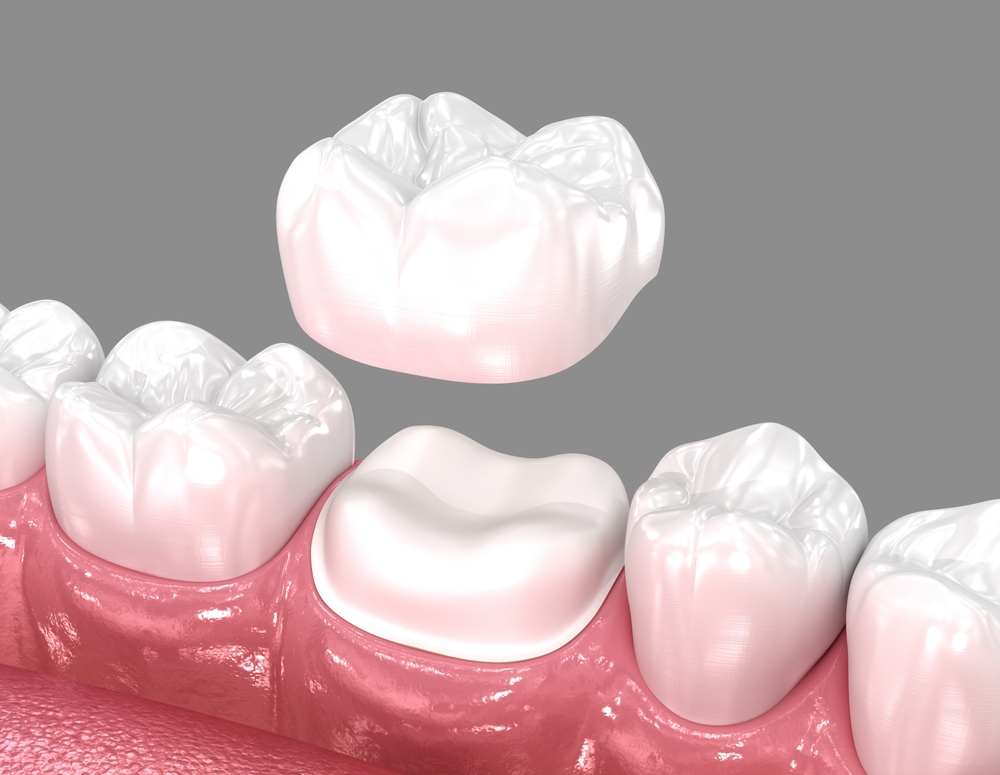 What Are Dental Crowns and Why Are They Needed?